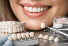Керамические виниры: что влияет на стоимость процедуры в Украине