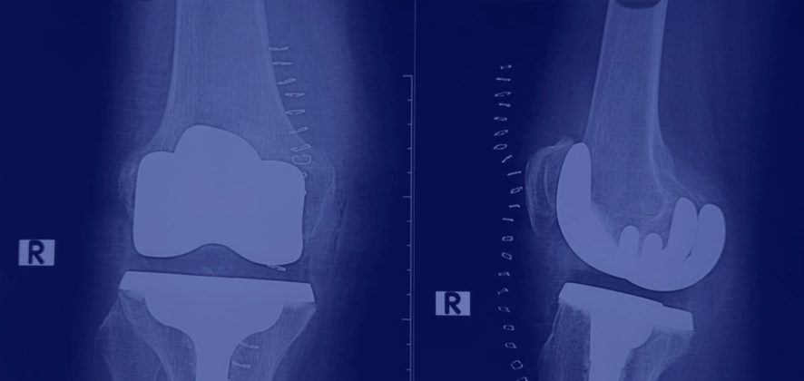Індивідуальний підхід до створення нових суглобів