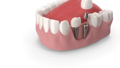 Як відновити зубний ряд: сучасні методи протезування на імплантах
