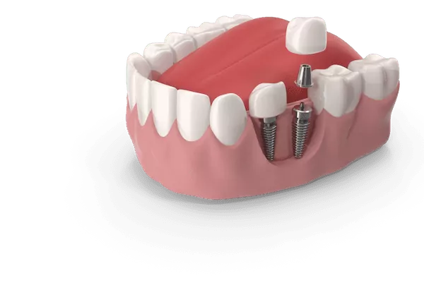 Як відновити зубний ряд: сучасні методи протезування на імплантах