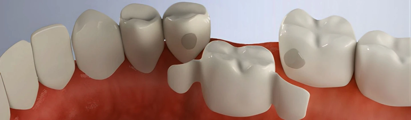 Переваги адгезивного моста 