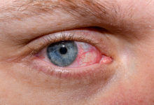 Understanding and Treating Dry Eye Syndrome - Myths and Facts - Laxmi Eye Hospital