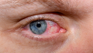 Understanding and Treating Dry Eye Syndrome - Myths and Facts - Laxmi Eye Hospital