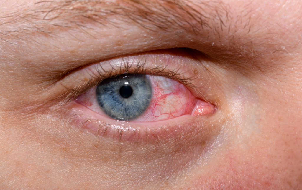 Understanding and Treating Dry Eye Syndrome - Myths and Facts - Laxmi Eye Hospital