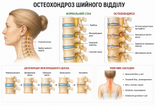 Схематичне порівняння здорового шийного відділу хребта та остеохондрозу з поясненням змін міжхребцевих дисків.